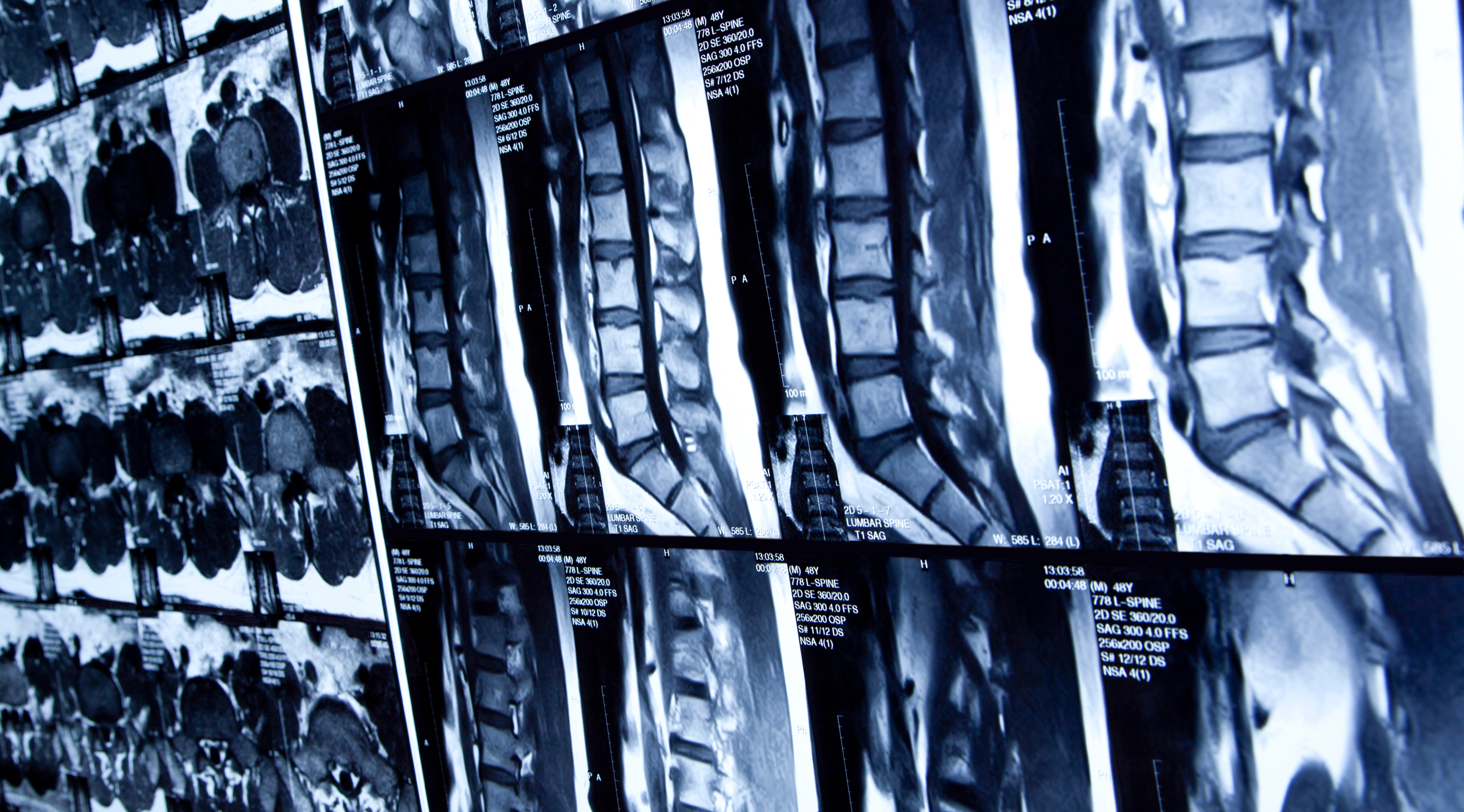 DEXA_Bone Density Scans